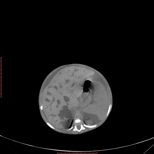 Autosomal recessive polycystic kidney disease associated with Caroli disease (Radiopaedia 61932-69984 B 136).jpg
