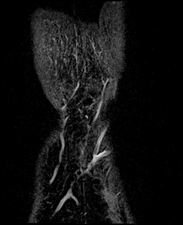 Avascular necrosis of the capitate (Radiopaedia 88317-104948 Coronal T1 vibe 96).jpg