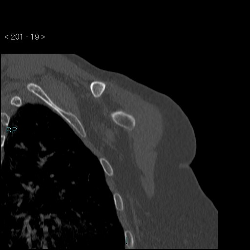 Avascular necrosis of the shoulder - Cruess stage I (Radiopaedia 77674-89887 Coronal bone window 18).jpg