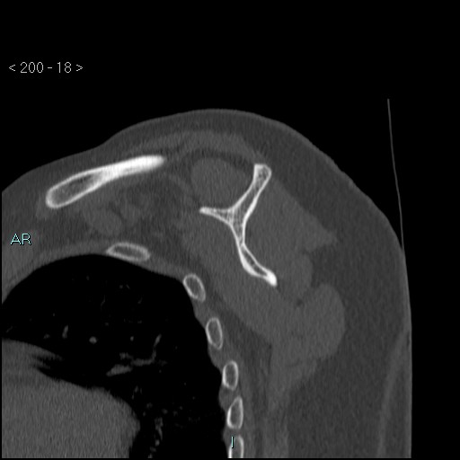 Avascular necrosis of the shoulder - Cruess stage I (Radiopaedia 77674-89887 Sagittal bone window 17).jpg