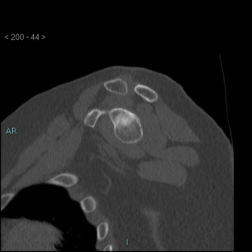 Avascular necrosis of the shoulder - Cruess stage I (Radiopaedia 77674-89887 Sagittal bone window 43).jpg