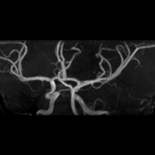 File:Azygos anterior cerebral artery (Radiopaedia 17059-16756 MRA 6).jpg