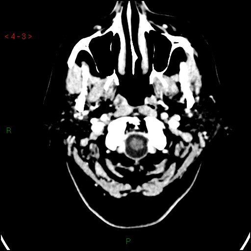 Azygos anterior cerebral artery (Radiopaedia 51987-57833 A 3).jpg