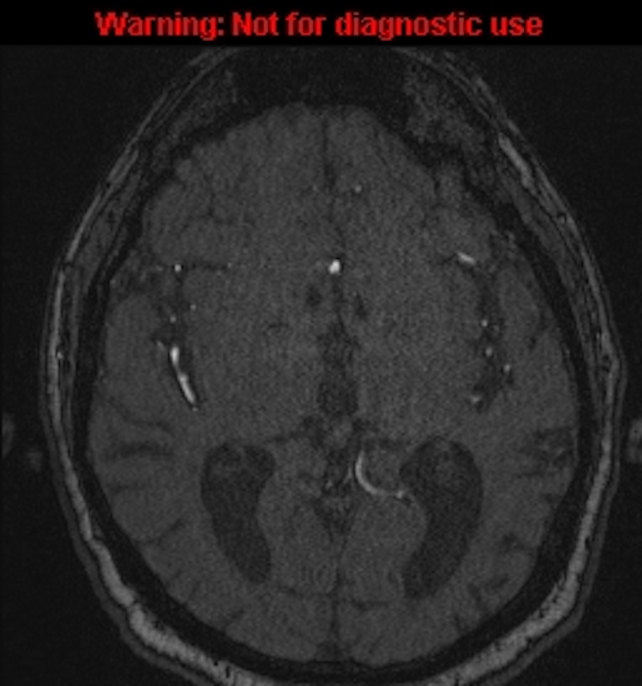 Azygos anterior cerebral artery (Radiopaedia 59325-66677 Axial MRA 85).jpg