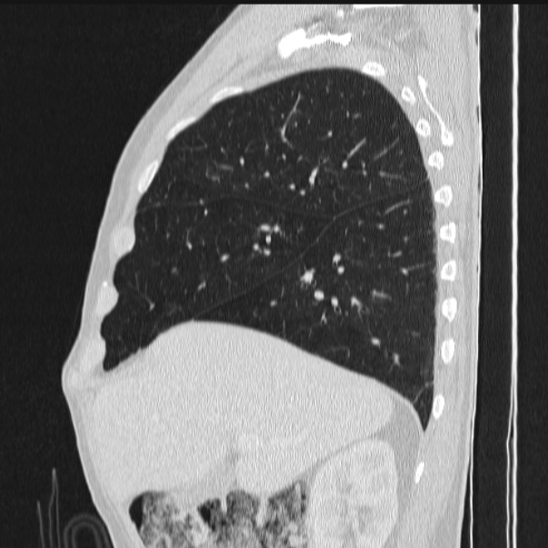 Azygos lobe (Radiopaedia 38259-40275 lung window 29).jpg