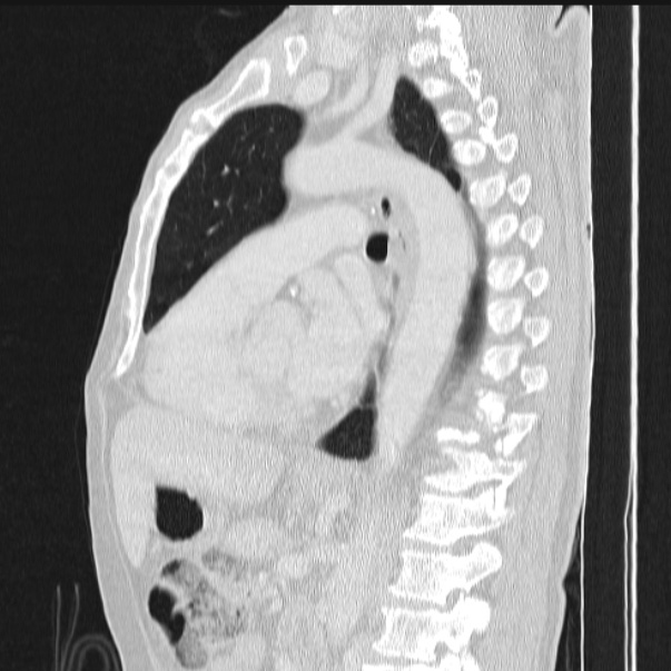Azygos lobe (Radiopaedia 38259-40275 lung window 57).jpg
