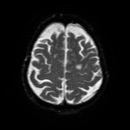 File:Balo concentric sclerosis (Radiopaedia 53875-59982 Axial DWI 44).jpg