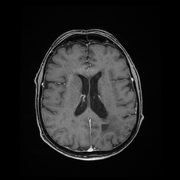 Balo concentric sclerosis (Radiopaedia 53875-59982 Axial LAVA C+ 158).jpg