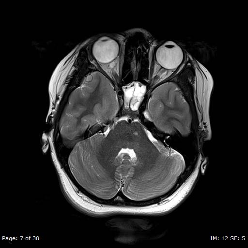 File:Balo concentric sclerosis (Radiopaedia 61637-69636 Axial T2 7).jpg