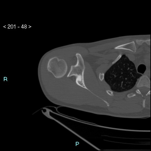 Bankart lesion with glenoid bone defect - assessment TC with PICO method (Radiopaedia 42855-93901 Axial bone window 47).jpg