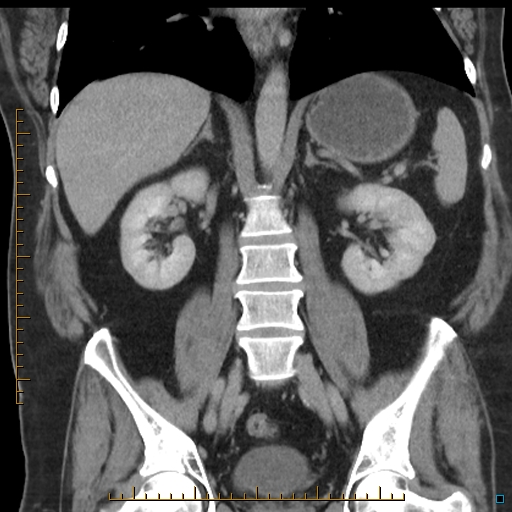 File:Bariatric balloon causing gastric outlet obstruction (Radiopaedia 54449-60672 B 37).jpg