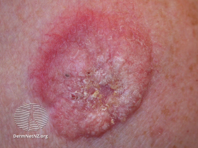 File:Basal cell carcinoma affecting the trunk (DermNet NZ lesions-bcc-trunk-1021).jpg