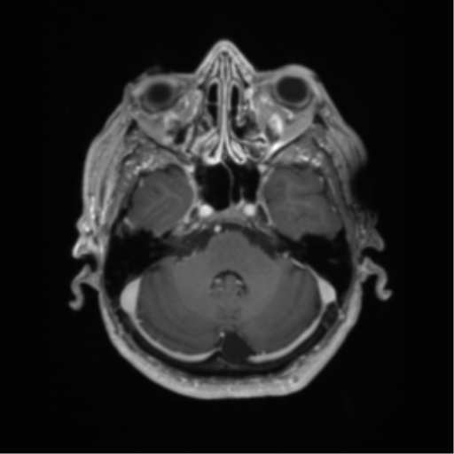 Basal ganglia metastasis (Radiopaedia 78928-91828 Axial T1 C+ 17).png