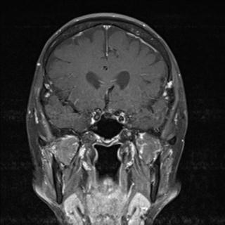 File:Base of skull chondrosarcoma (Radiopaedia 30410-31070 G 2).jpg