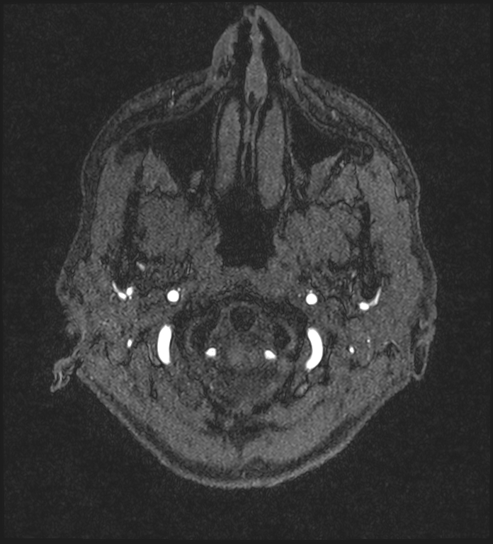 Basilar artery perforator aneurysm (Radiopaedia 82455-97733 Axial MRA 9).jpg