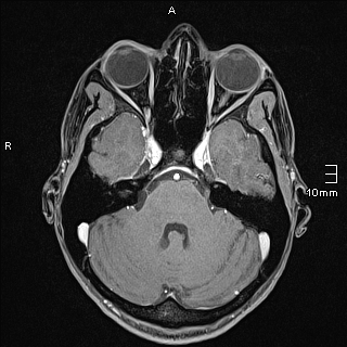 Basilar artery perforator aneurysm (Radiopaedia 82455-99523 G 35).jpg