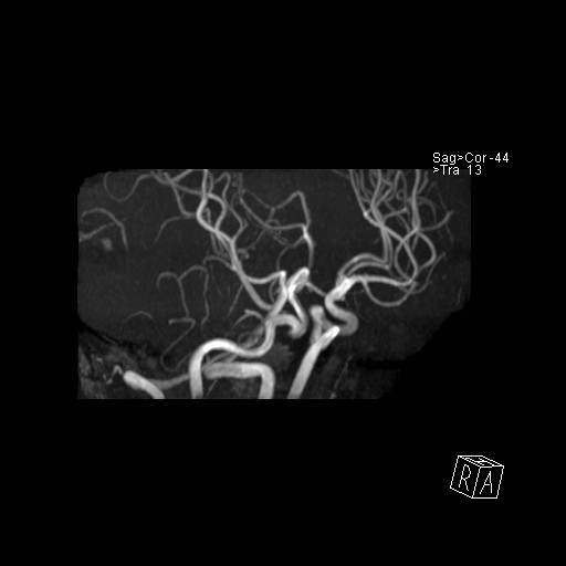 Basilar tip aneurysm (Radiopaedia 26504-26632 D 36).jpg
