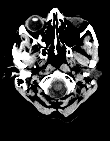 File:Basilar tip aneurysm with coiling (Radiopaedia 53912-60033 Axial 27).jpg