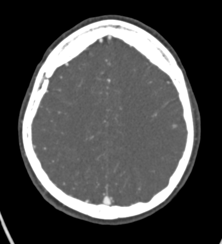 File:Basilar tip aneurysm with coiling (Radiopaedia 53912-60086 A 110).jpg