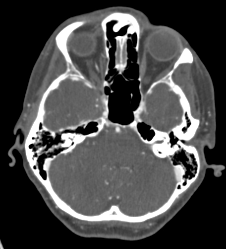 Basilar tip aneurysm with coiling (Radiopaedia 53912-60086 A 41).jpg
