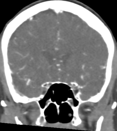 Basilar tip aneurysm with coiling (Radiopaedia 53912-60086 B 50).jpg