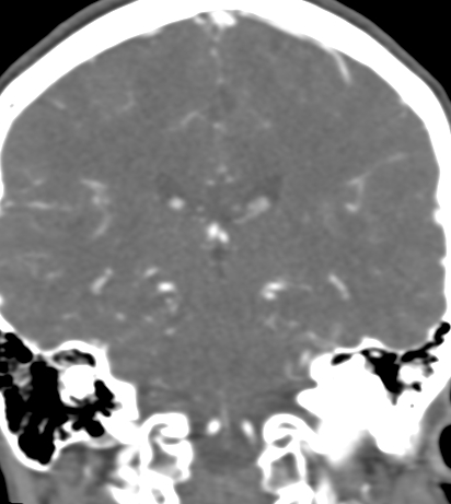 Basilar tip aneurysm with coiling (Radiopaedia 53912-60086 B 93).jpg