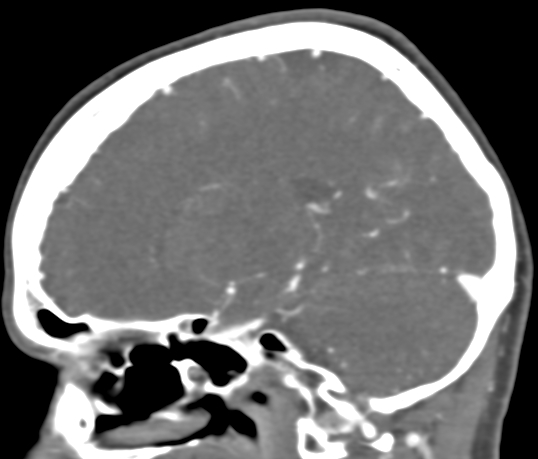 Basilar tip aneurysm with coiling (Radiopaedia 53912-60086 C 49).jpg