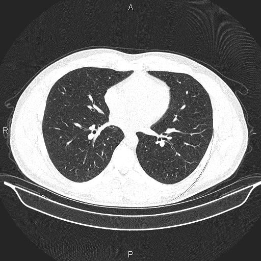 Beam hardening and ring artifacts (Radiopaedia 85323-100915 Axial lung window 45).jpg