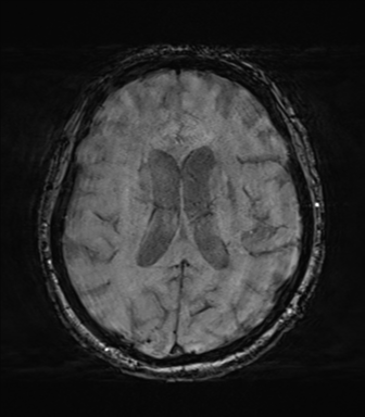 File:Behavioral variant frontotemporal dementia and late onset schizophrenia (Radiopaedia 52197-58083 Axial SWI 44).png