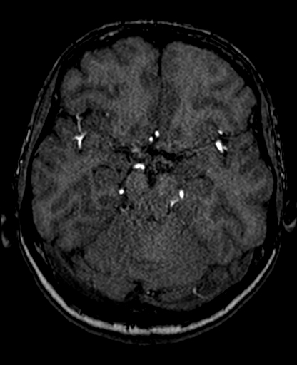 Berry aneurysm of the terminal internal carotid artery (Radiopaedia 88286-104918 Axial TOF 103).jpg