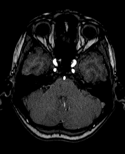 File:Berry aneurysm of the terminal internal carotid artery (Radiopaedia 88286-104918 Axial TOF 78).jpg