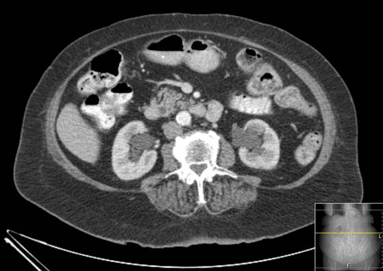 Bicameral celiacomesenteric aneurysm (Radiopaedia 55766-62327 A 30).jpg