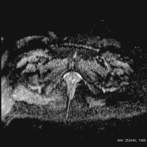File:Bicornuate uterus- on MRI (Radiopaedia 49206-54297 Axial ADC 23).jpg