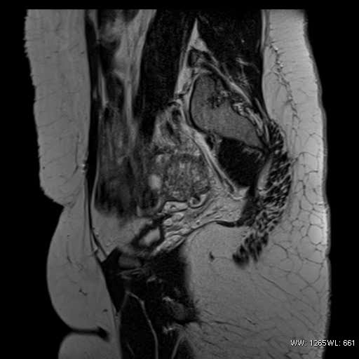 File:Bicornuate uterus- on MRI (Radiopaedia 49206-54297 Sagittal T2 6).jpg