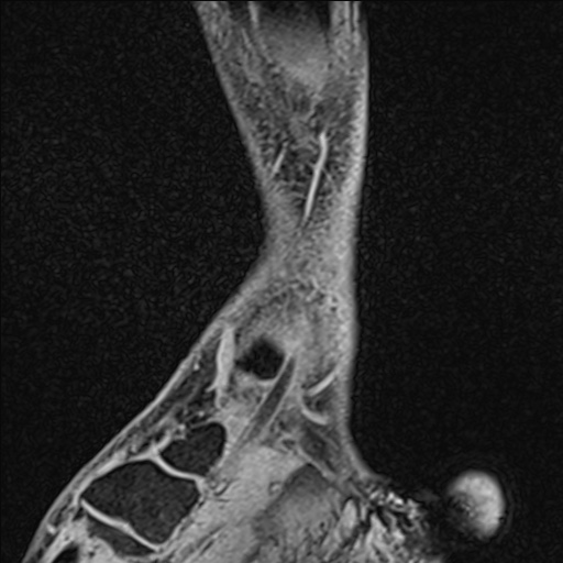 Bilateral Achilles tendon complete tear (Radiopaedia 81344-95051 Sagittal WE - Right 89).jpg