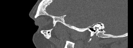 Bilateral Ectopic Infraorbital Nerves (Radiopaedia 49006-54084 Sagittal bone window 2).jpg