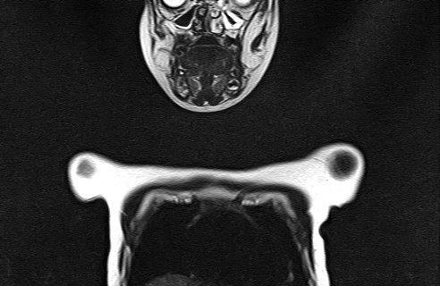 File:Bilateral Sprengel deformity with Klippel-Feil syndrome (Radiopaedia 66395-75650 Coronal T2 1).jpg