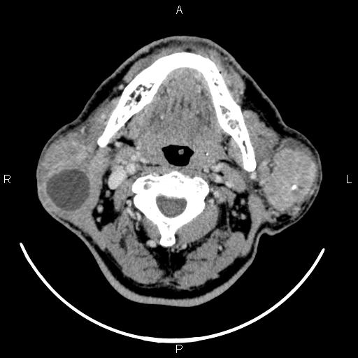 Bilateral Warthin tumors (Radiopaedia 84034-99263 Axial With contrast 27).jpg