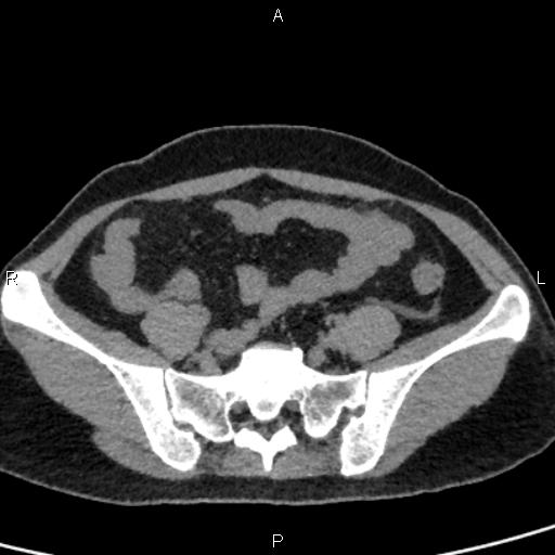 File:Bilateral adrenal gland hyperenhancement in pancreatitis (Radiopaedia 86642-102753 Axial non-contrast 85).jpg