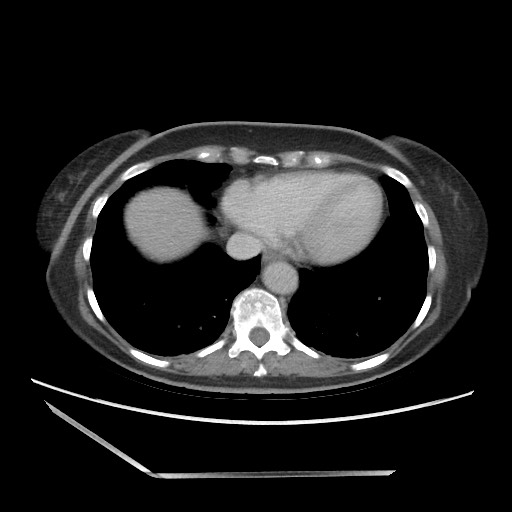 File:Bilateral adrenal granulocytic sarcomas (chloromas) (Radiopaedia 78375-91007 A 12).jpg