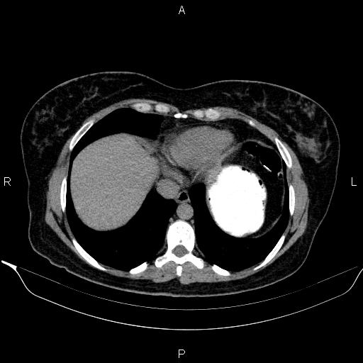 Bilateral adrenal myelolipoma (Radiopaedia 63058-71535 Axial non-contrast 11).jpg