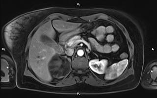 File:Bilateral adrenal myelolipoma (Radiopaedia 63058-71537 Axial T1 C+ fat sat 35).jpg