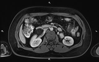 Bilateral adrenal myelolipoma (Radiopaedia 63058-71537 G 49).jpg