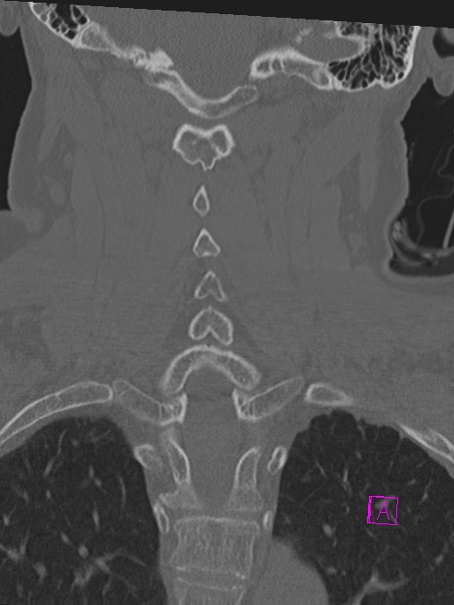 Bilateral atlanto-occipital assimilation (Radiopaedia 28350-28603 Coronal bone window 30).jpg