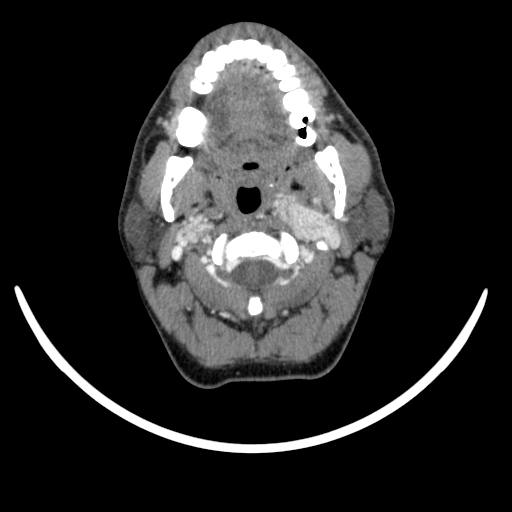 Bilateral carotid body tumors (Radiopaedia 52899-58827 A 34).jpg