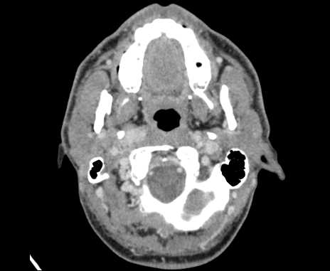 Bilateral carotid body tumors (Radiopaedia 61841-69870 Axial Post contrast 17).jpg