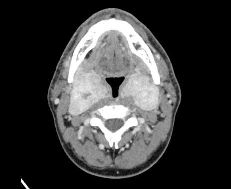 File:Bilateral carotid body tumors (Radiopaedia 61841-69870 Axial Post contrast 41).jpg