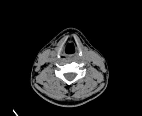 File:Bilateral carotid body tumors (Radiopaedia 61841-69870 Axial non-contrast 66).jpg