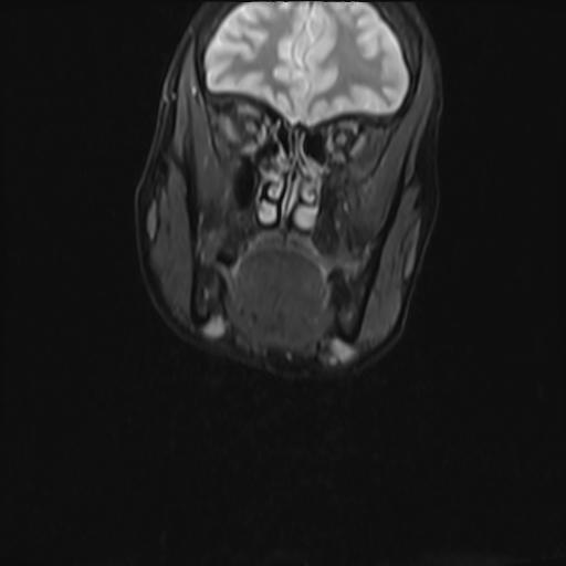 File:Bilateral carotid body tumors and right jugular paraganglioma (Radiopaedia 20024-20060 Coronal 42).jpg