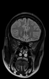 File:Bilateral carotid body tumors and right jugular paraganglioma (Radiopaedia 20024-20060 Coronal 69).jpg